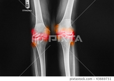 Osteoarthritis Right knee film x-ray Osteoarthritis Right knee film x-ray 43669731