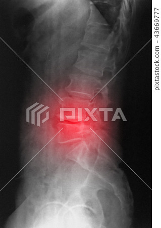 Computed radiography (CR) of lumbosarcal spine 43669777