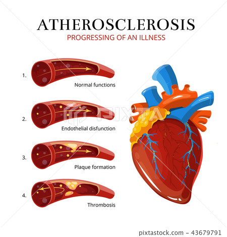 Atherosclerosis, blood clot formation. Vector medical illustration Atherosclerosis, blood clot formation. Vector medical illustration 43679791