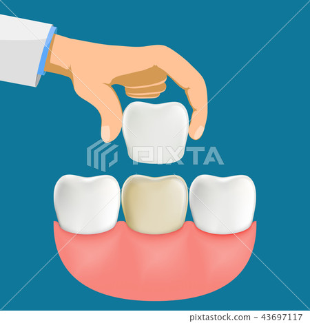 Dentist installation porcelain dental veneers. 43697117