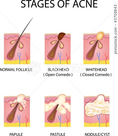 Stages of acne formation in the human skin 43708643
