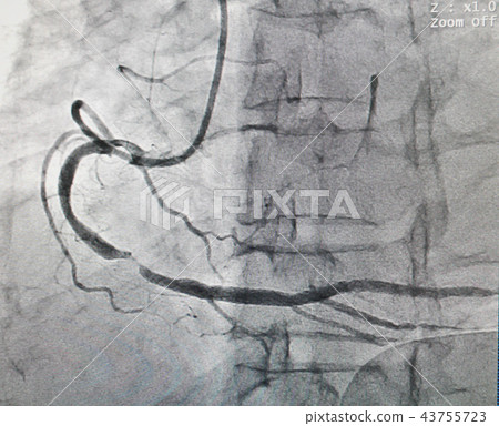 Coronary artery disease 43755723