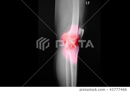 osteoarthritis knee patient and artificial joint 43777466