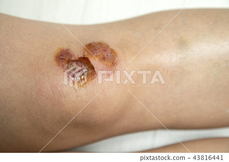 Knee bruise 43816441