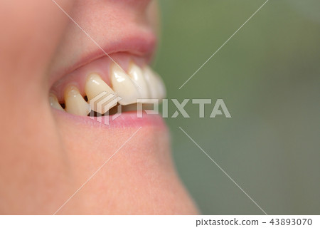 Woman teeth parodontose Woman teeth parodontose 43893070