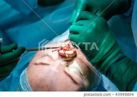 Surgeon and his assistant performing cosmetic surgery on nose in hospital operating room. Nose Surgeon and his assistant performing cosmetic surgery on nose in hospital operating room. Nose 43949804