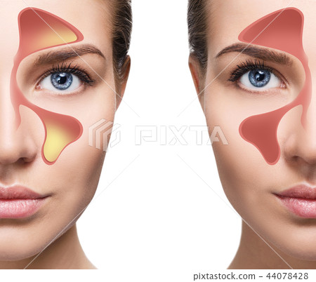 Female face shows nasal sinus with cold over white background. Female face shows nasal sinus with cold over white background. 44078428