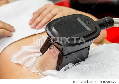 Woman getting cryolipolysis fat treatment Woman getting cryolipolysis fat treatment 44096830