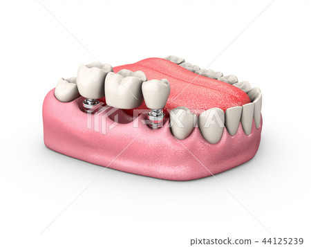 3d Illustration of a Fixed partial denture bridge, isolated white 44125239