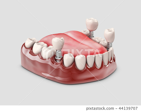 Human teeth and Dental implant. 3d illustration 44139707