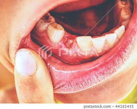 Child showing the first canine tooth pulled out. Child showing the first canine tooth pulled out. 44181435