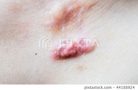 Scar on human skin 44188924