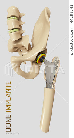 Hip joint replacement, artificial joint 3d Illustration Hip joint replacement, artificial joint 3d Illustration 44193342