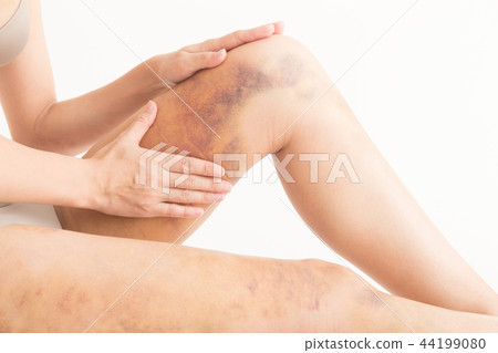 Liposuction, scars, women (white background) 44199080
