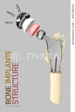 Hip joint structure, artificial joint 3d Illustration 44199263