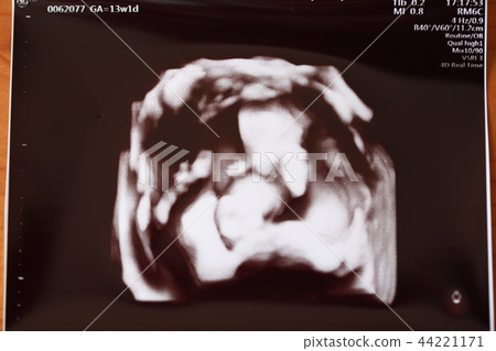 3D迴聲攝影 44221171