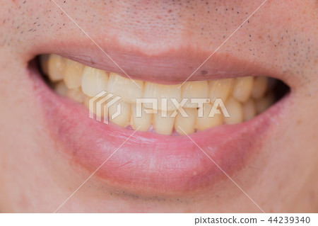yellow teeth in male from smoke and coffee 44239340