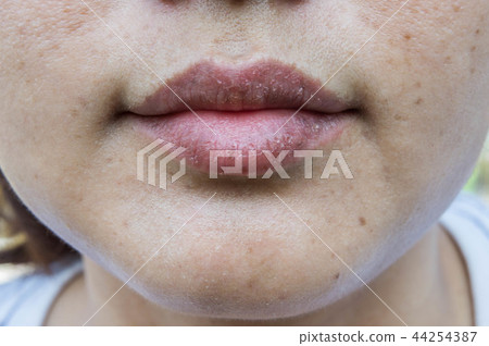 dry lips, Lack of skin lips maintenance 44254387