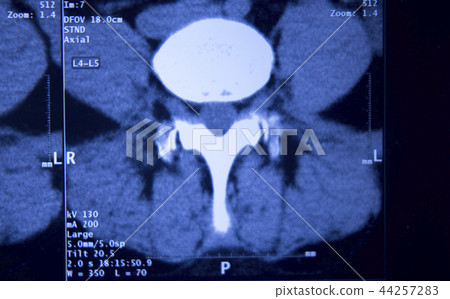 Medical hips spine pelvis MRI scan Medical hips spine pelvis MRI scan 44257283