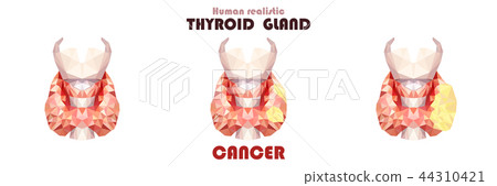 Realistic thyroid gland in low poly. Inflammation Realistic thyroid gland in low poly. Inflammation 44310421