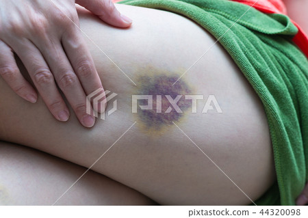 A girl show a big purple bruise on her left leg. A girl show a big purple bruise on her left leg. 44320098