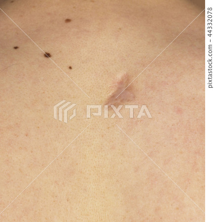 scar on the back of a man, close-up 44332078