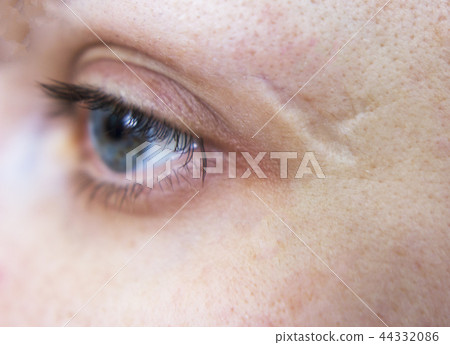 Scar on the girl's temple, close-up Scar on the girl's temple, close-up 44332086