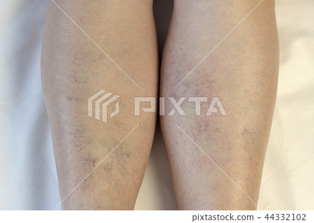 Varicose veins on legs, white background Varicose veins on legs, white background 44332102