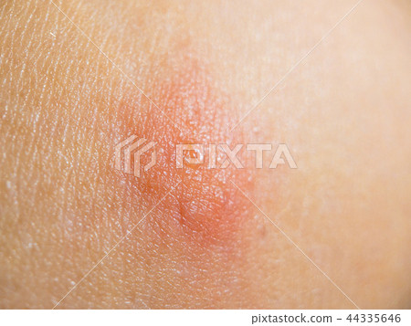 Bite insect on female skin 44335646