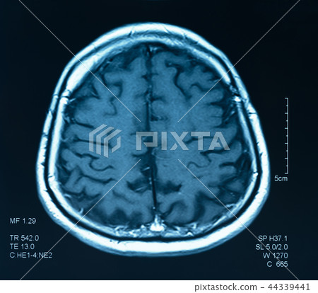 mri scan brain 44339441