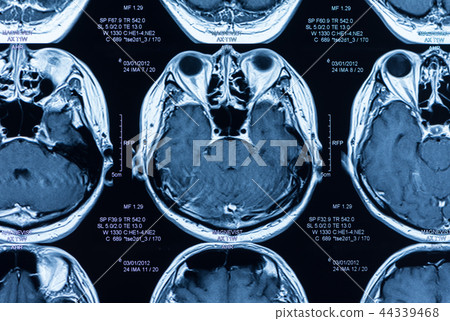 brain mri scan 44339468