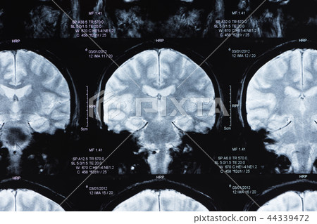 brain mri 44339472