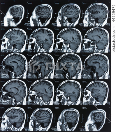 x-ray film image of bra 44339473