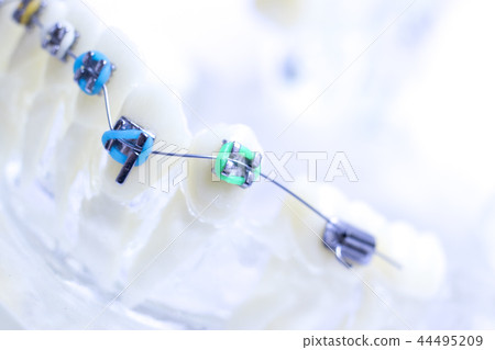 Dental metal brace teeth model Dental metal brace teeth model 44495209