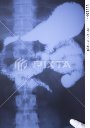 Medical xray spine hip scan 44495233