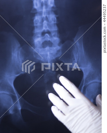 Medical xray spine hip scan 44495237