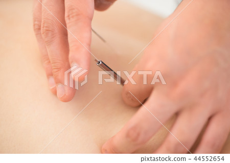 針灸,手的特寫鏡頭 針灸,手的特寫鏡頭 44552654