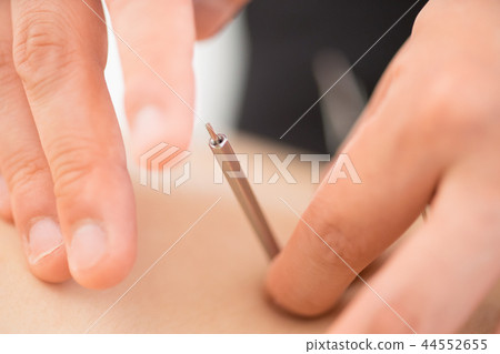 Acupuncture, close-up of the hand 44552655