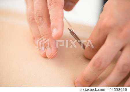 Acupuncture, close-up of the hand 44552656