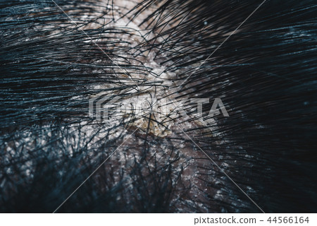 Hair scalp with dandruff and scaly from psoriasis 44566164