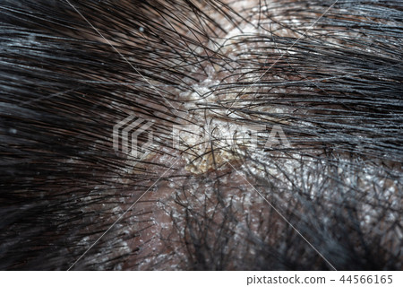 Hair scalp with dandruff and scaly from psoriasis 44566165