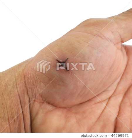 a hand wound with stitches a hand wound with stitches 44569971