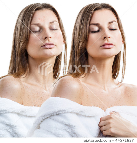 Young woman in bathrobe with acne before and after treatment and make-up Young woman in bathrobe with acne before and after treatment and make-up 44571657