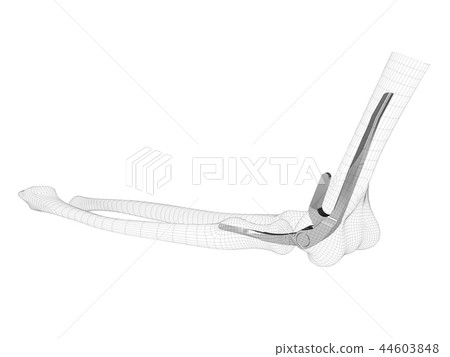 the endoprosthesis of the elbow joint 44603848