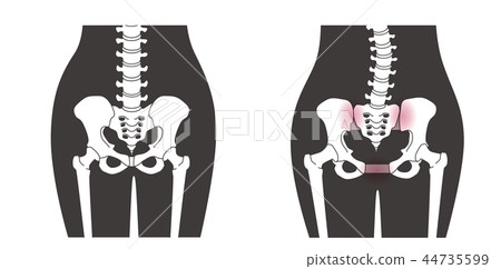 骨盆鬆動 骨盆鬆動 44735599