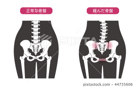 Loose pelvis - Stock Illustration [44735606] - PIXTA