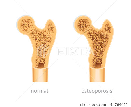 Healthy and osteoporosis human bone 44764421