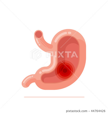 Stomach ulcer concept flat design 44764426