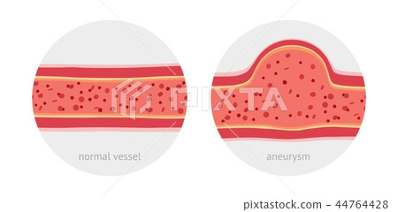 Healthy and sick aneurysm human vessel 44764428