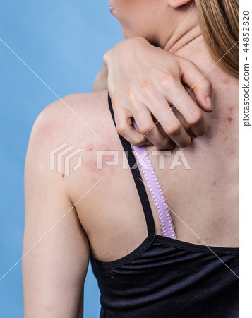 Woman with skin problem acne on back Woman with skin problem acne on back 44852820